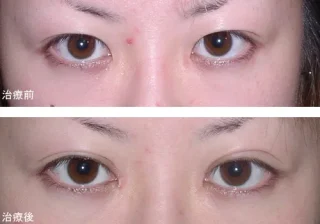 目頭切開