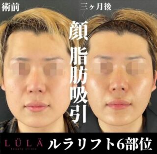 ルラ式クイック小顔脂肪吸引・ルラリフト6部位