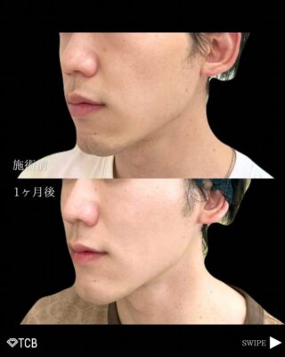 小顔美肌再生（リフトアップ）