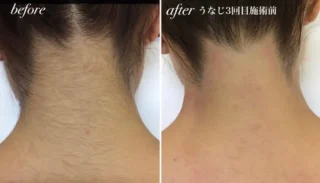 うなじ脱毛