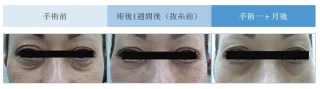 目の下タルミ取り