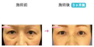 目の下の切らないクマ・たるみ（ふくらみ）取り 他