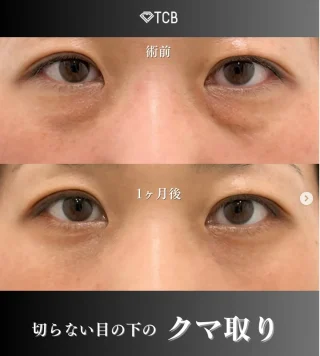 切らない目の下のクマ取り・たるみ取り