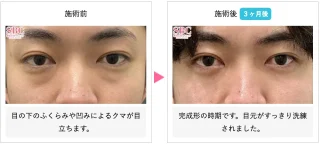裏ハムラ法