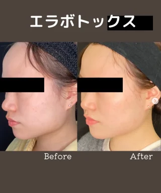 エラボトックス
