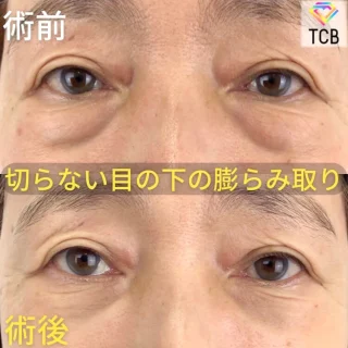 切らない目の下のクマ取り・目の下のたるみ（ふくらみ）取り