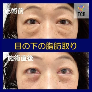 切らない目の下のクマ取り・目の下のたるみ（ふくらみ）取り