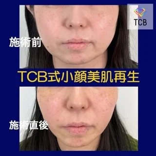小顔美肌再生（リフトアップ）
