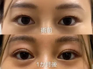 二重埋没法 2点留め