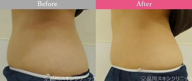 品川美容クリニック エバースリム 症例写真