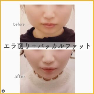 エラ削り+バッカルファット施術