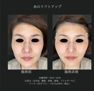 糸リフト