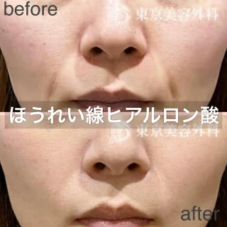 ほうれい線のヒアルロン酸注射