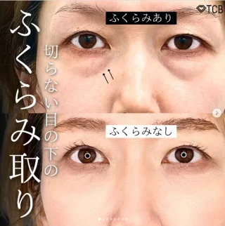 切らない⽬の下のクマ取り・たるみ取り