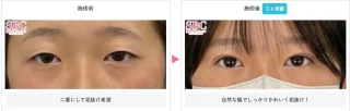 線留めクロス二重術