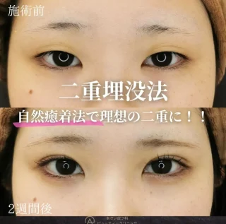 二重埋没自然癒着法
