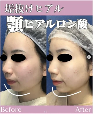 顎ヒアルロン酸