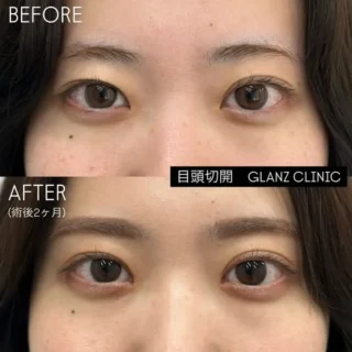 目頭切開