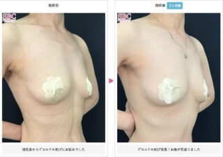 週末豊胸 -ピュアグラフト-(脂肪注入豊胸)