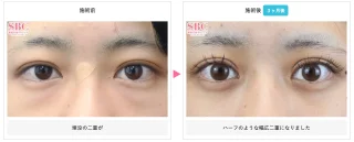 タルミ取り併用全切開法二重