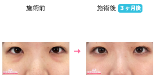 目の下の切らないクマ・たるみ（ふくらみ）取り 他