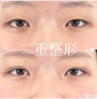 TCB式1dayクイックアイ(プレミアムエタニティ)