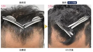 AGA薄毛治療