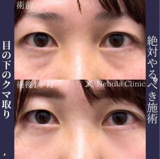 切らない目の下のクマ取り・たるみ取り