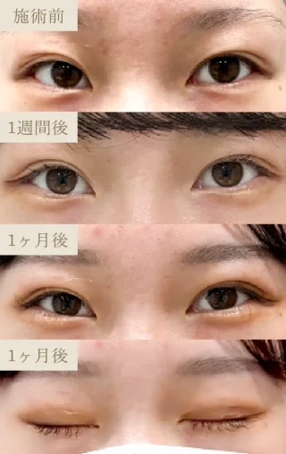 CBCプレミアム二重術