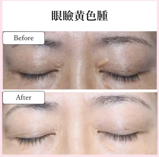 眼瞼黄色