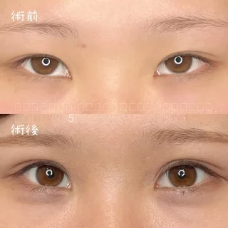 二重埋没法