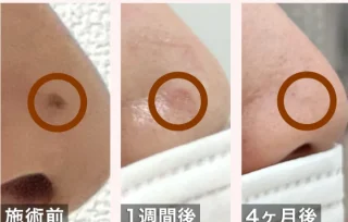 CO2レーザー