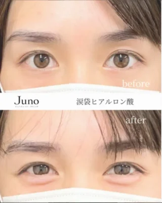 涙袋ヒアルロン酸