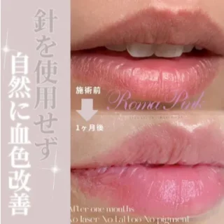 スコール金沢 美容クリニック 施術 ローマピンク