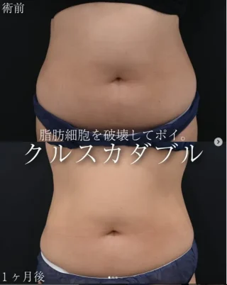 クールスカルプティング(R)・ エリート(クルスカダブル)
