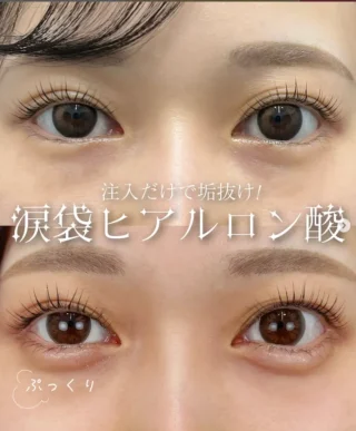 涙袋ヒアルロン酸
