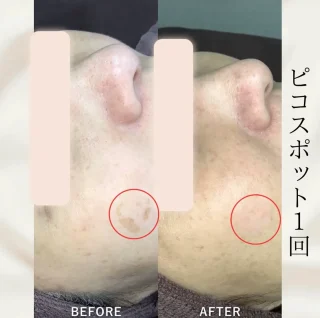 ピコスポット