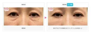 目の下の切らないクマ・たるみ（ふくらみ）取り