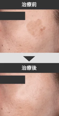 フラル式シミレーザー治療