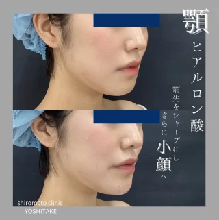 顎のヒアルロン酸注入