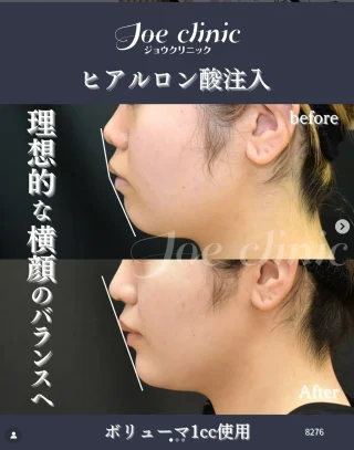 顎ヒアルロン酸注入