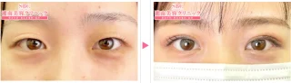 線留めクロス二重術