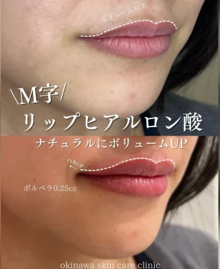 リップのヒアルロン酸