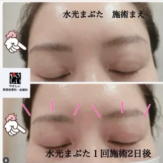 水光注射