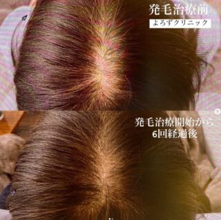 ハーグ療法 ASCE+(AGA治療)