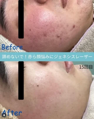 ジェネシスレーザー