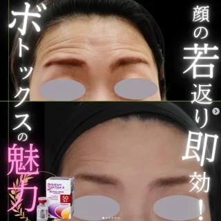 額ボトックス