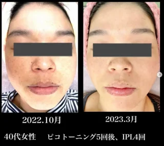 ピコトーニング5回+IPL4回