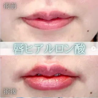 唇のヒアルロン酸注射