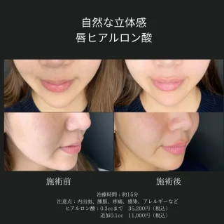 くちびるヒアルロン酸